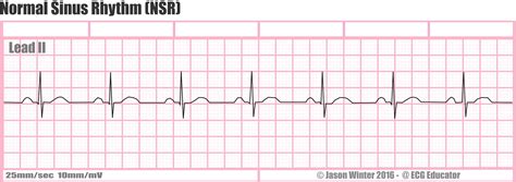 Heart rate can be easily calculated from the ECG strip: When the rhythm is regular, the heart rate is 300 divided by the number of large squares between the QRS complexes. For example, if there are 4 large squares between regular QRS complexes, the heart rate is 75 (300/4=75). The second method can be used with an irregular rhythm to estimate ... 